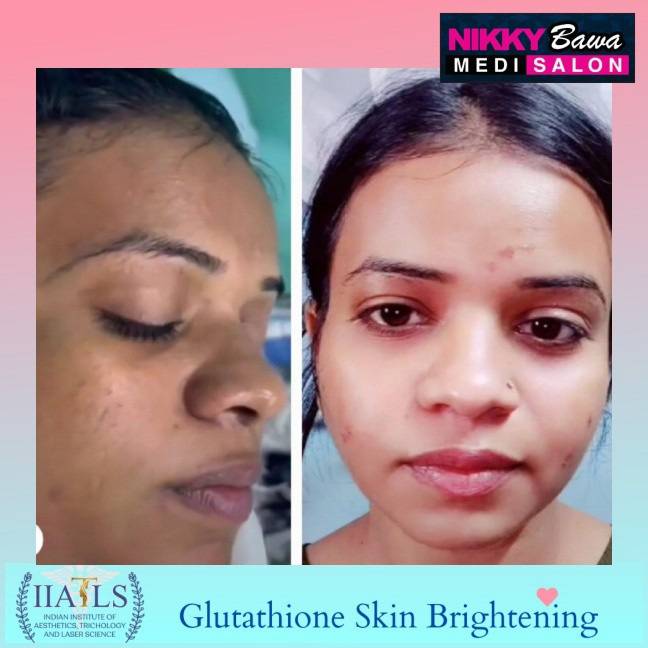 glutathione injection how many sessions for skin whitening NAD vs Glutathione: Key Differences and Benefits Explained main image 1